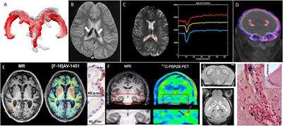 Clinical Imaging of Choroid Plexus in Health and in Brain Disorders: A Mini-Review